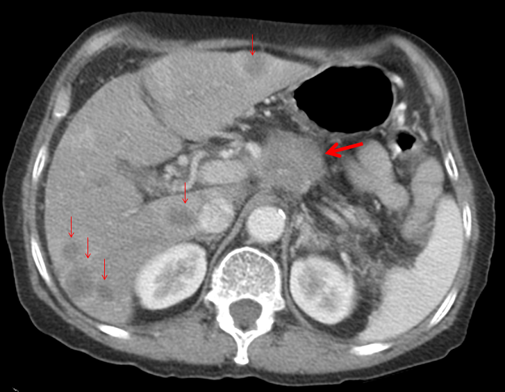 Blood Test IDs Pancreatic Cancer in 250 of 250 Patients Drug