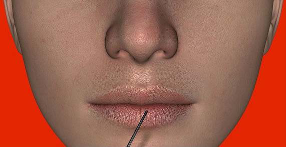 Data Supports Advancement of Botox as Depression Treatment - Drug ...