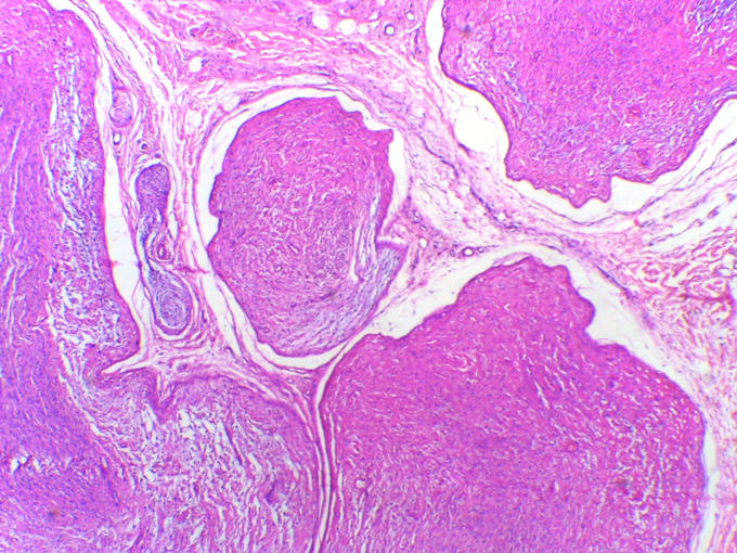 Neurofibroma with lobulated pattern,lobules showing bundles of spindle cells in a myxoid stroma. H&E stain. (Department of Pathology, Calicut Medical College, Wikimedia)