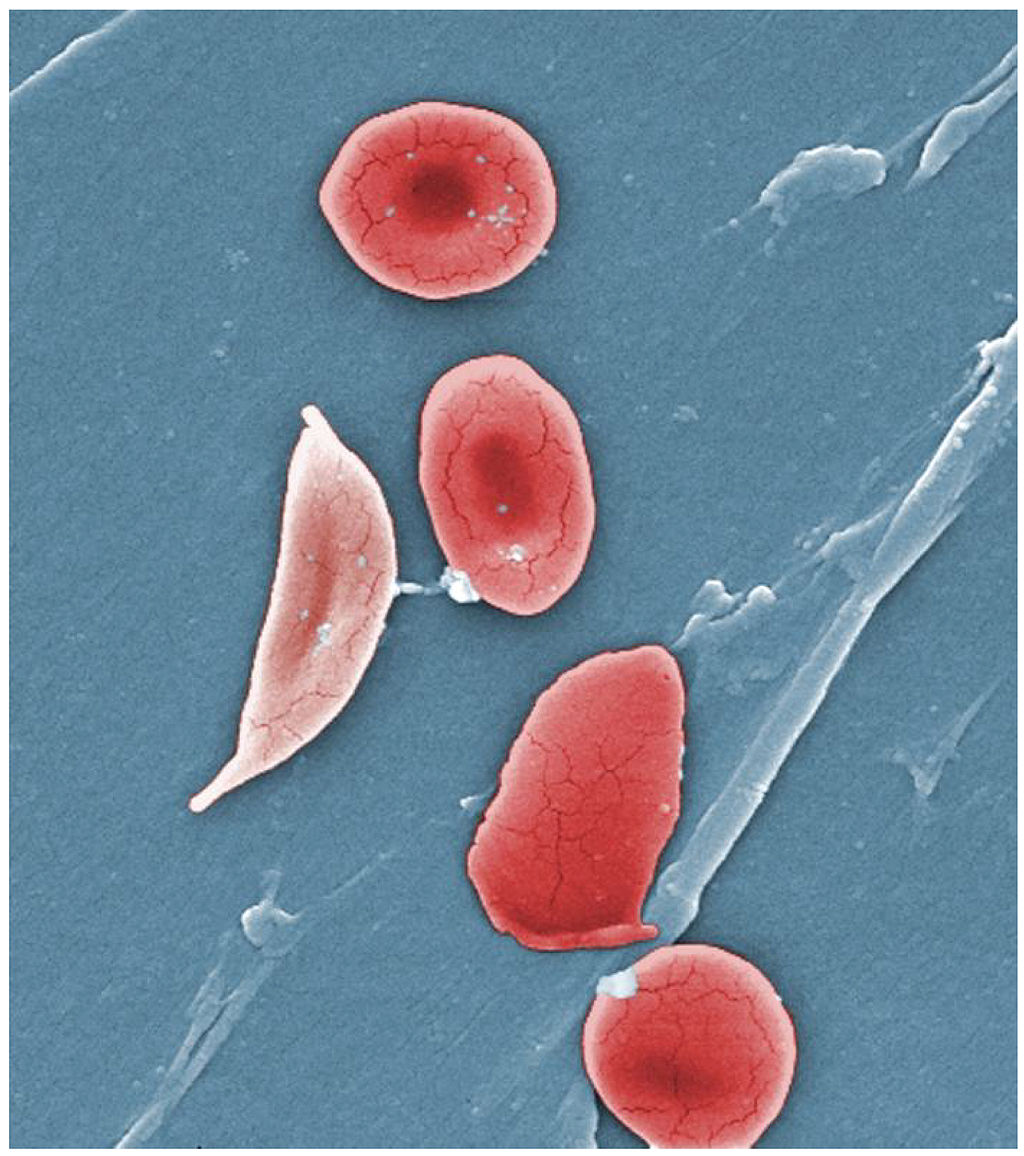 Normal blood cells next to a sickle-blood cell, colored scanning electron microscope image (Credit: OpenStax College)