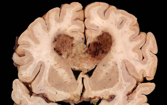 Human brain specimen with glioblastoma multiforme. (Source: UCSD)