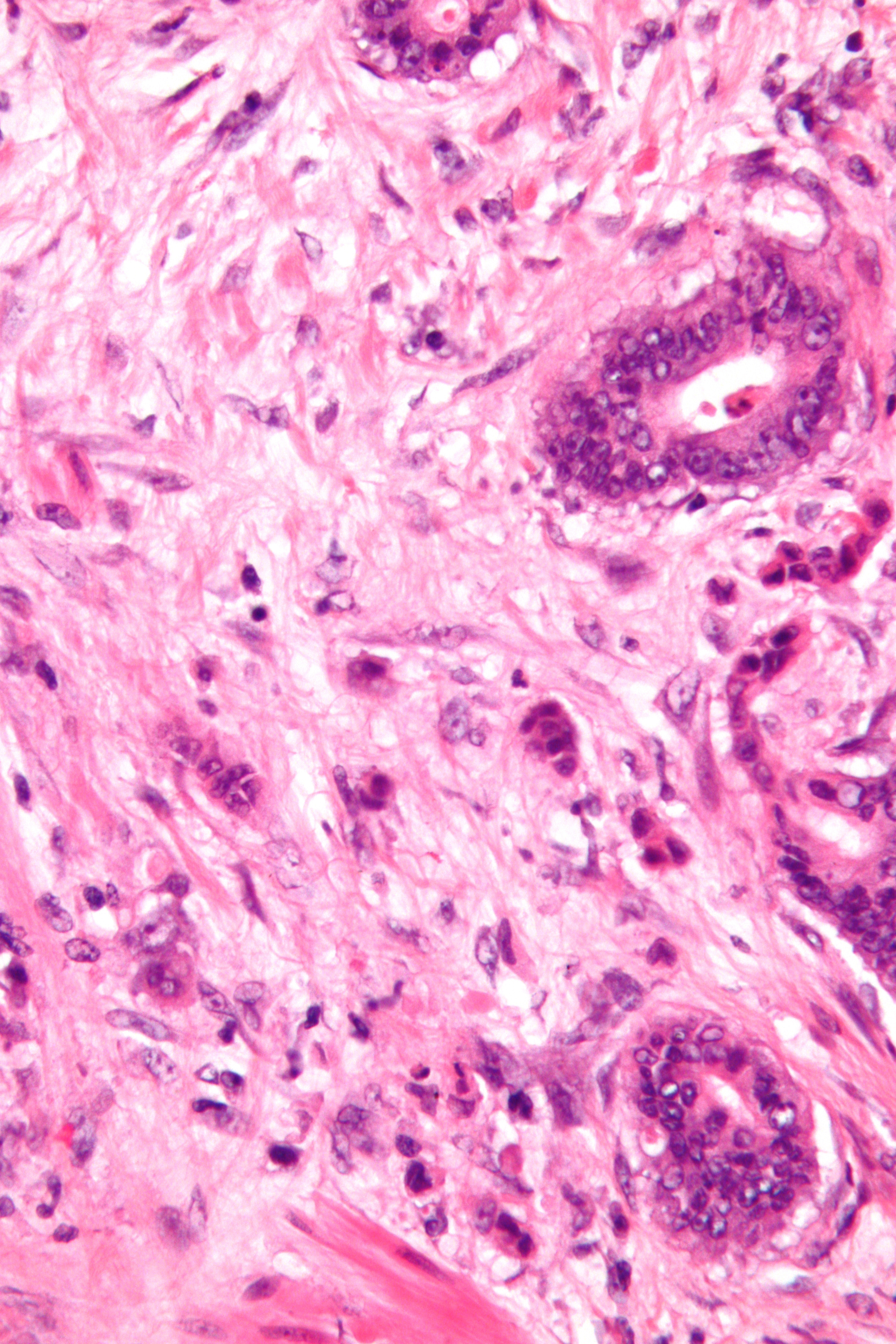 Colon cancer cells. (Source: Wikimedia/Nephron)