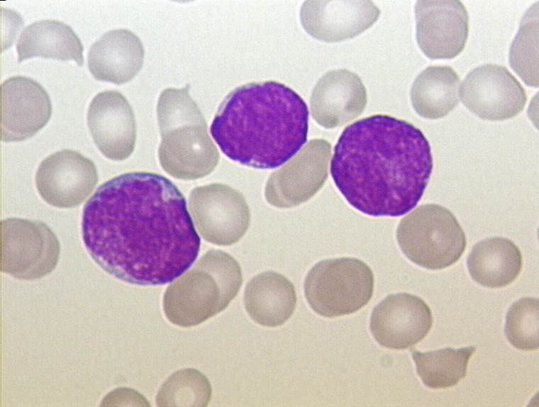 Acute lymphoblastic leukemia (ALL), peripheral blood of a child. (Source: Wikimedia/Christaras A.)