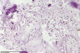 Gram stain of C. novyi-NT germination in a dog tumor. The darker rod-shaped bacteria are visible throughout the image. (Source: Johns Hopkins Medicine/David L. Huso and Baktiar Karim)