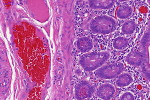 Image of human intestine from patient with inflammatory disease. Source: University of Manchester