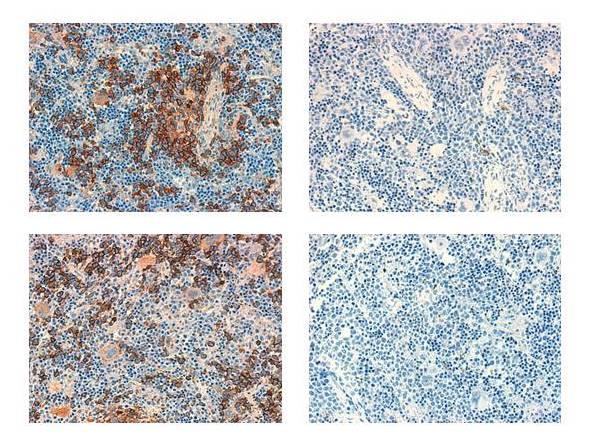 Mouse spleens that were infiltrated by TAL1-positive T-ALL leukemia cells taken from human patients, with leukemia cells shown in brown. Images on the right are from mice treated with GSK-J4, while the mice on the left were not treated with the compound. Reproduced with permission of Dr. Aissa Benyoucef. Source: Dr. Aissa Benyoucef 