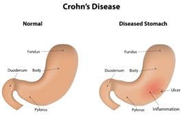 Crohn's disease