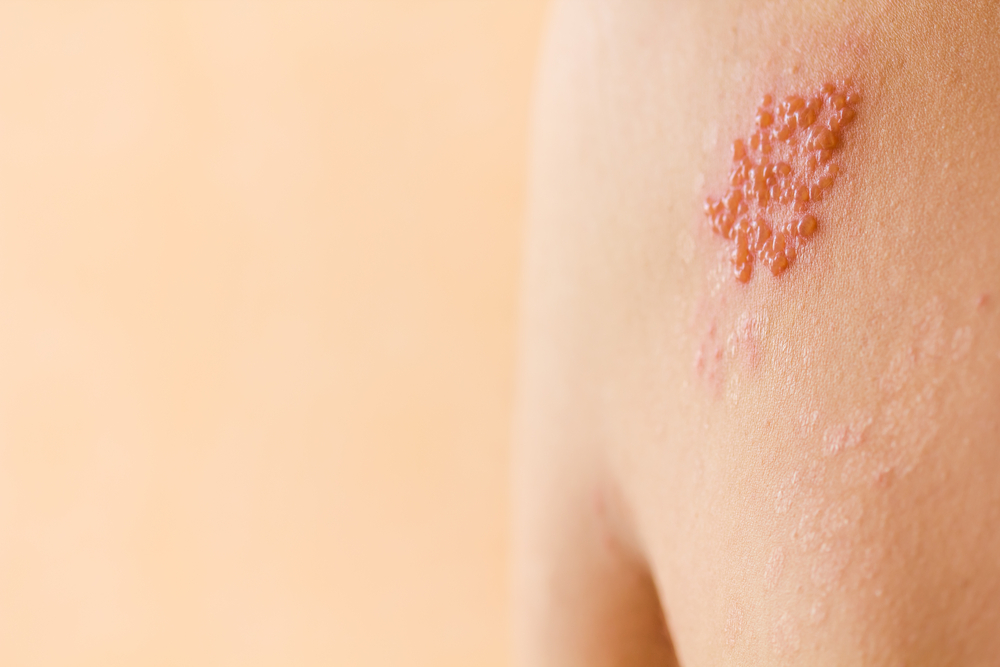 Shingrix Outbreak Rash GSK’s Shingrix Receives Positive Opinion from CHMP for Prevention of ...
