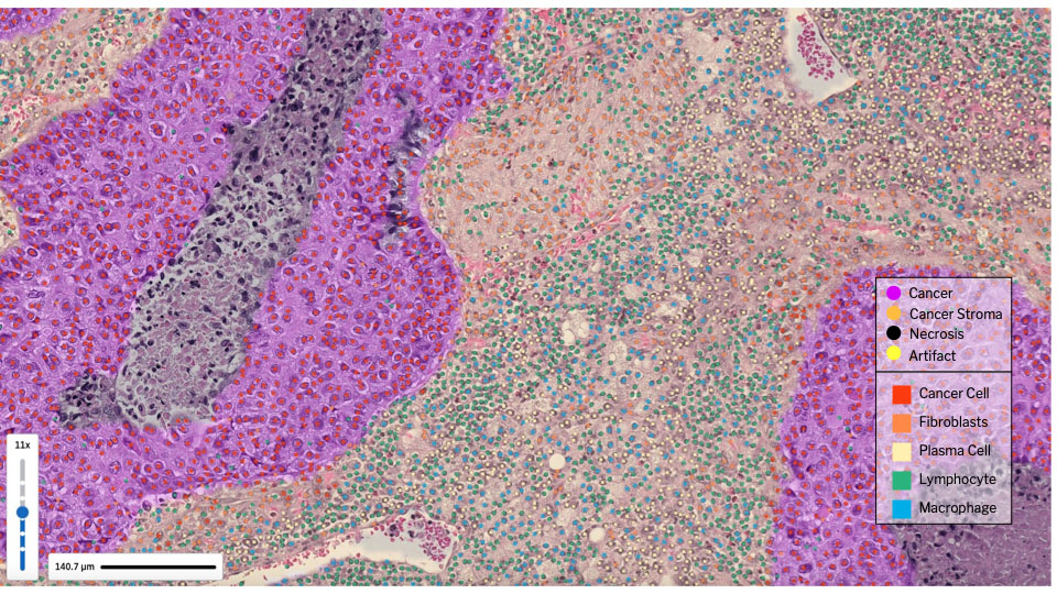 AI-generated tissue heatmaps and cell identification of the tumor microenvironment, overlaid on a digitized image of an H&E slide. 