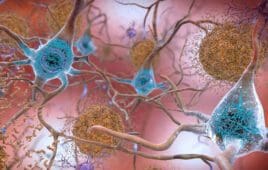 Beta-Amyloid Plaques and Tau in the Brain.