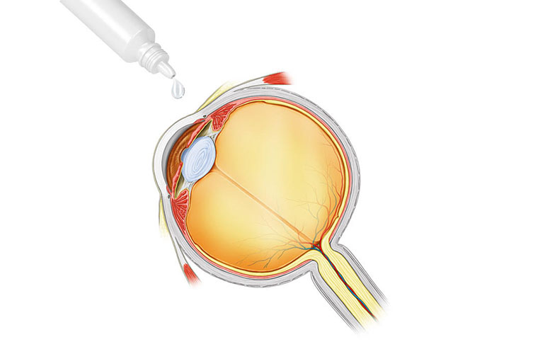 Trefoil Therapeutics' drug boosts postcataract surgery recovery