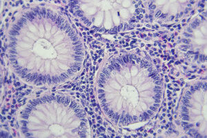 Colon cancer microscopic photography, magnification x400