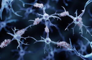 Alzheimer's disease plaques