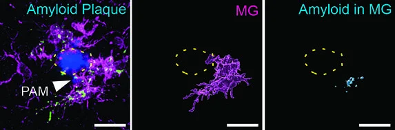 A new weapon against Alzheimer's: enhanced microglia (magenta) clearing toxic amyloid plaques (blue). A promising preclinical study from Cedars-Sinai.Credit: Cedars-Sinai